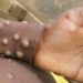 Toronto Public Health investigates first suspected case of monkeypox