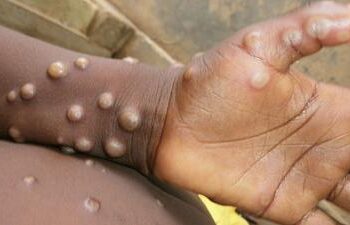 Toronto Public Health investigates first suspected case of monkeypox