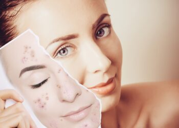 Top 10 Ways to clear Acne