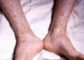 Toronto Public Health reports meningococcal disease outbreak in Toronto