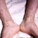 Toronto Public Health reports meningococcal disease outbreak in Toronto