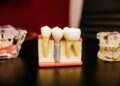 Advantages of Dental Implant